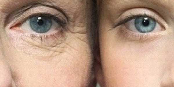 درمان چروک دور چشم با لیزر درمانی