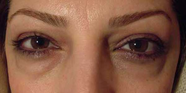 درمان پف چشم با لیزر